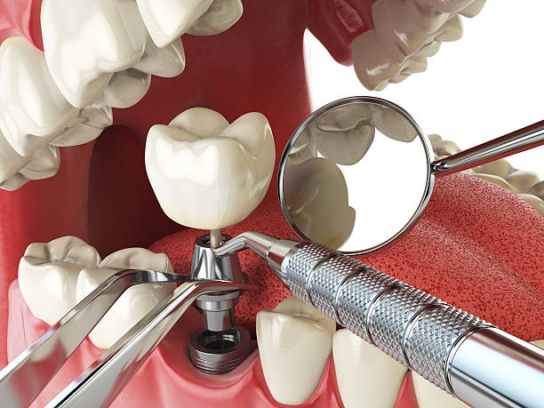 Best Lost Filling or Crown Replacement in Victoria, TX